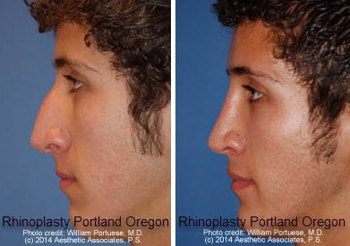 Rhinoplasty Costs Portland Oregon Rhinoplasty Costs Portland Oregon