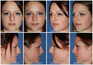 Rhinoplasty Costs Portland Oregon Rhinoplasty Costs Portland Oregon