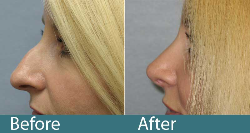 Rhinoplasty Costs Raleigh North Carolina Rhinoplasty Costs Raleigh North Carolina