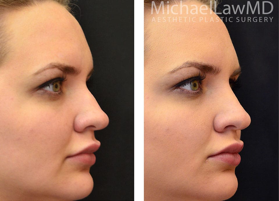 Rhinoplasty Costs Raleigh North Carolina Rhinoplasty Costs Raleigh North Carolina