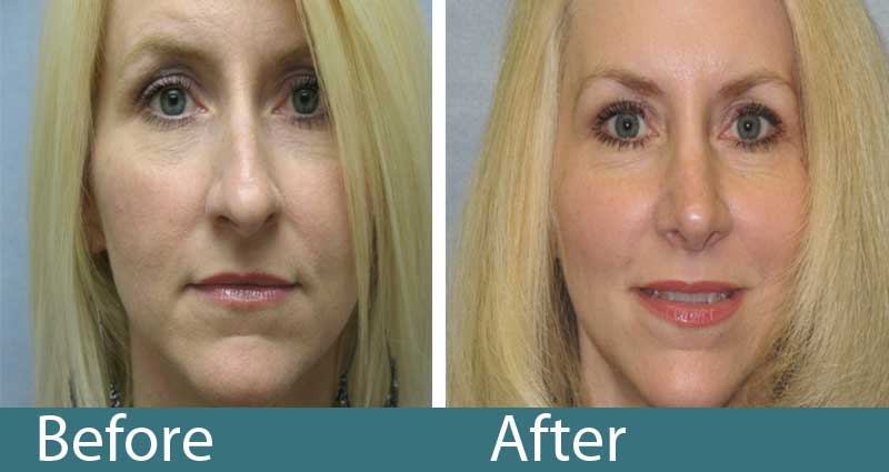 Rhinoplasty Costs Raleigh North Carolina Rhinoplasty Costs Raleigh North Carolina