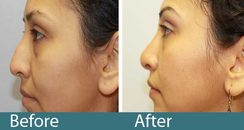 Rhinoplasty Costs Raleigh North Carolina Rhinoplasty Costs Raleigh North Carolina