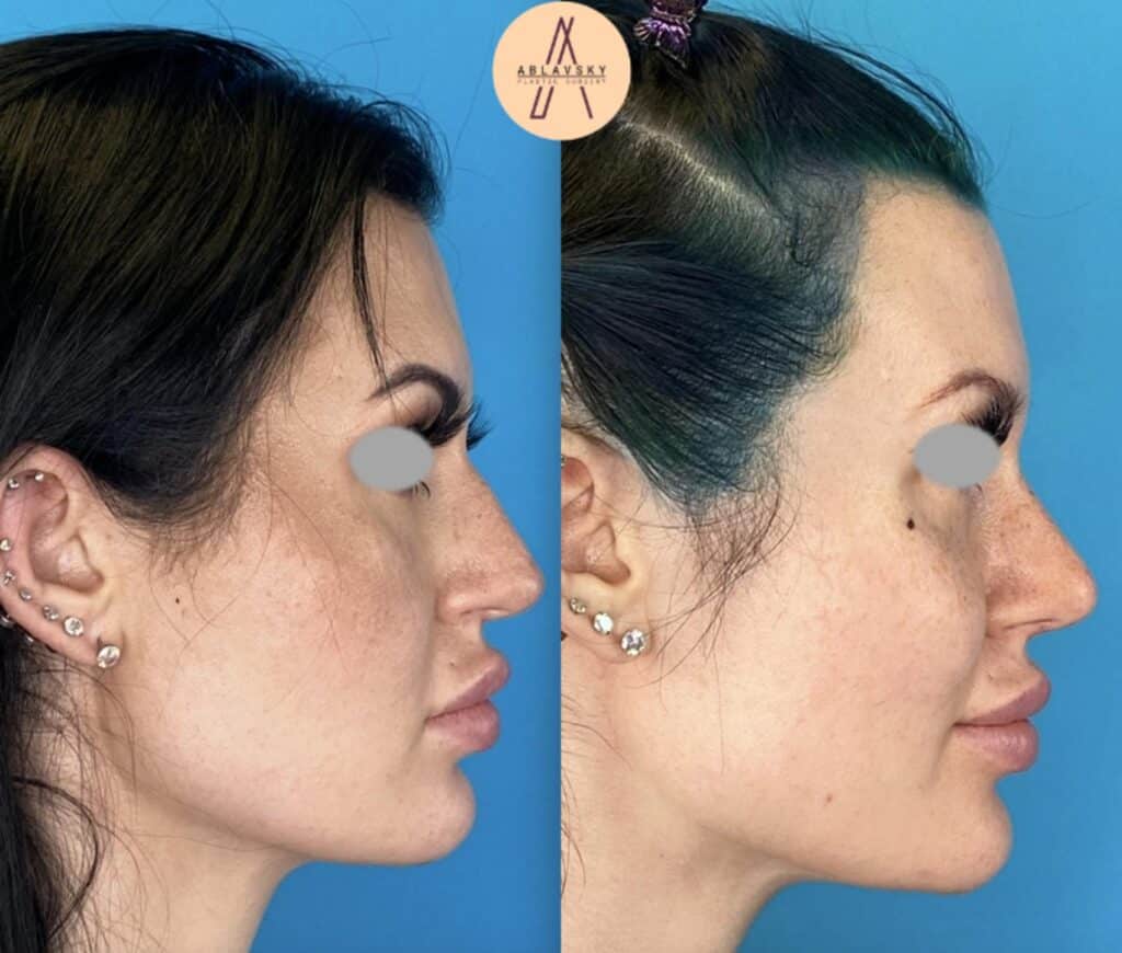 Rhinoplasty Costs San Antonio Texas Rhinoplasty Costs San Antonio Texas
