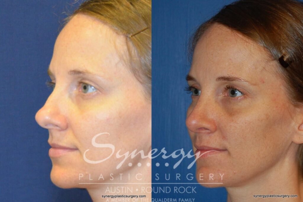 Rhinoplasty Costs San Antonio Texas Rhinoplasty Costs San Antonio Texas