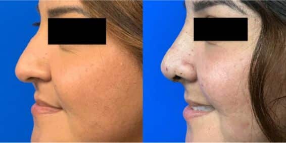 Rhinoplasty Costs San Antonio Texas Rhinoplasty Costs San Antonio Texas