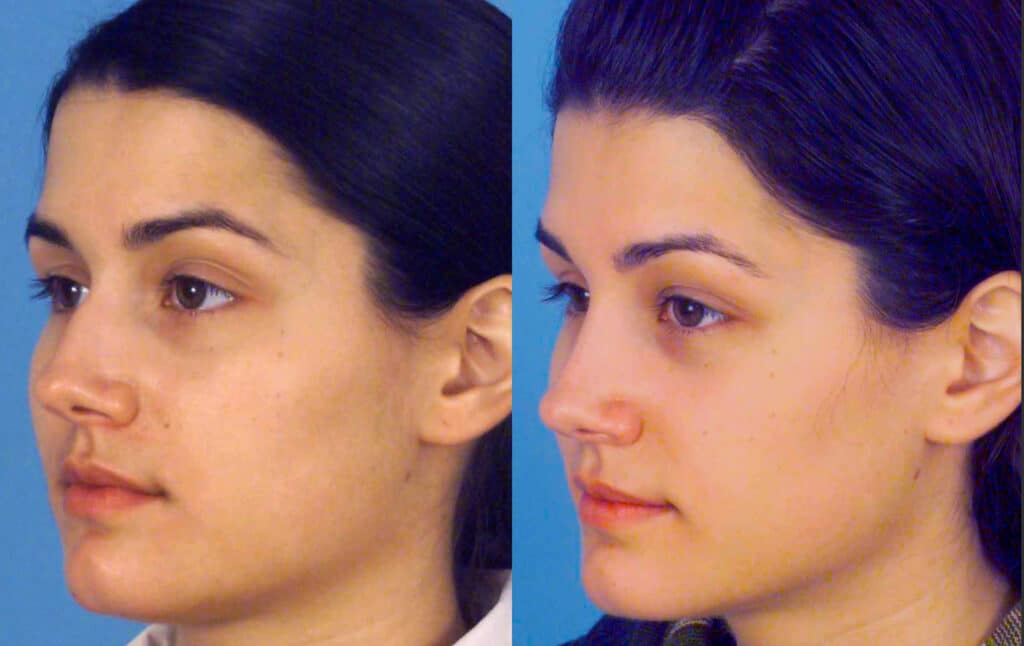 Rhinoplasty Costs San Diego California Rhinoplasty Costs San Diego California