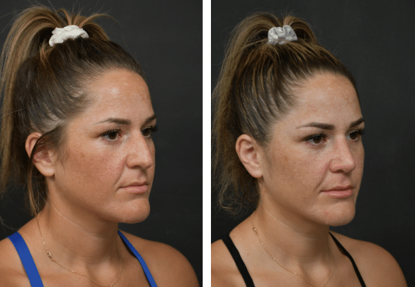 rhinoplasty costs san diego california 1