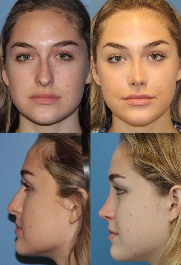 Rhinoplasty Costs San Diego California Rhinoplasty Costs San Diego California