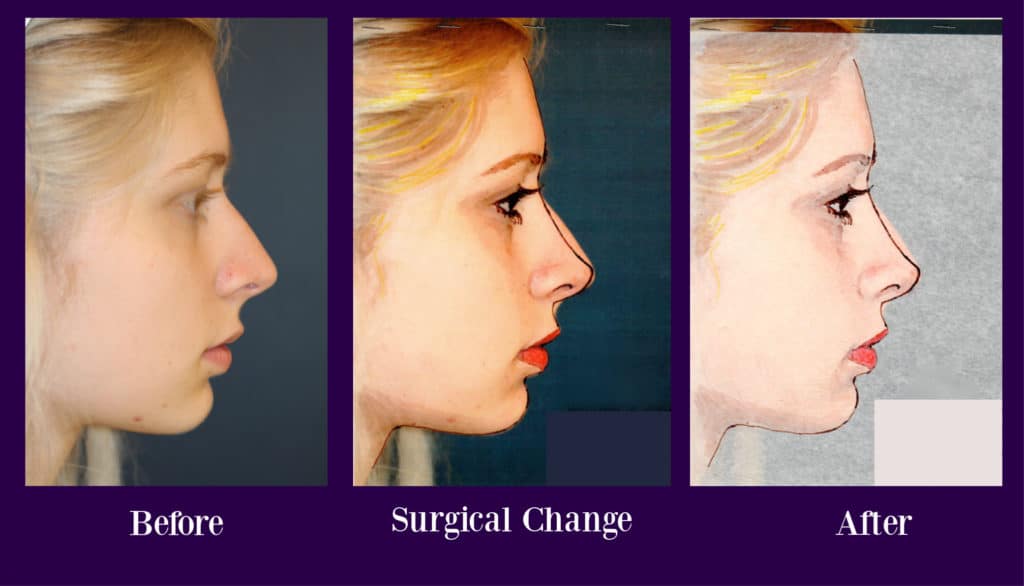 Rhinoplasty Costs San Diego California Rhinoplasty Costs San Diego California