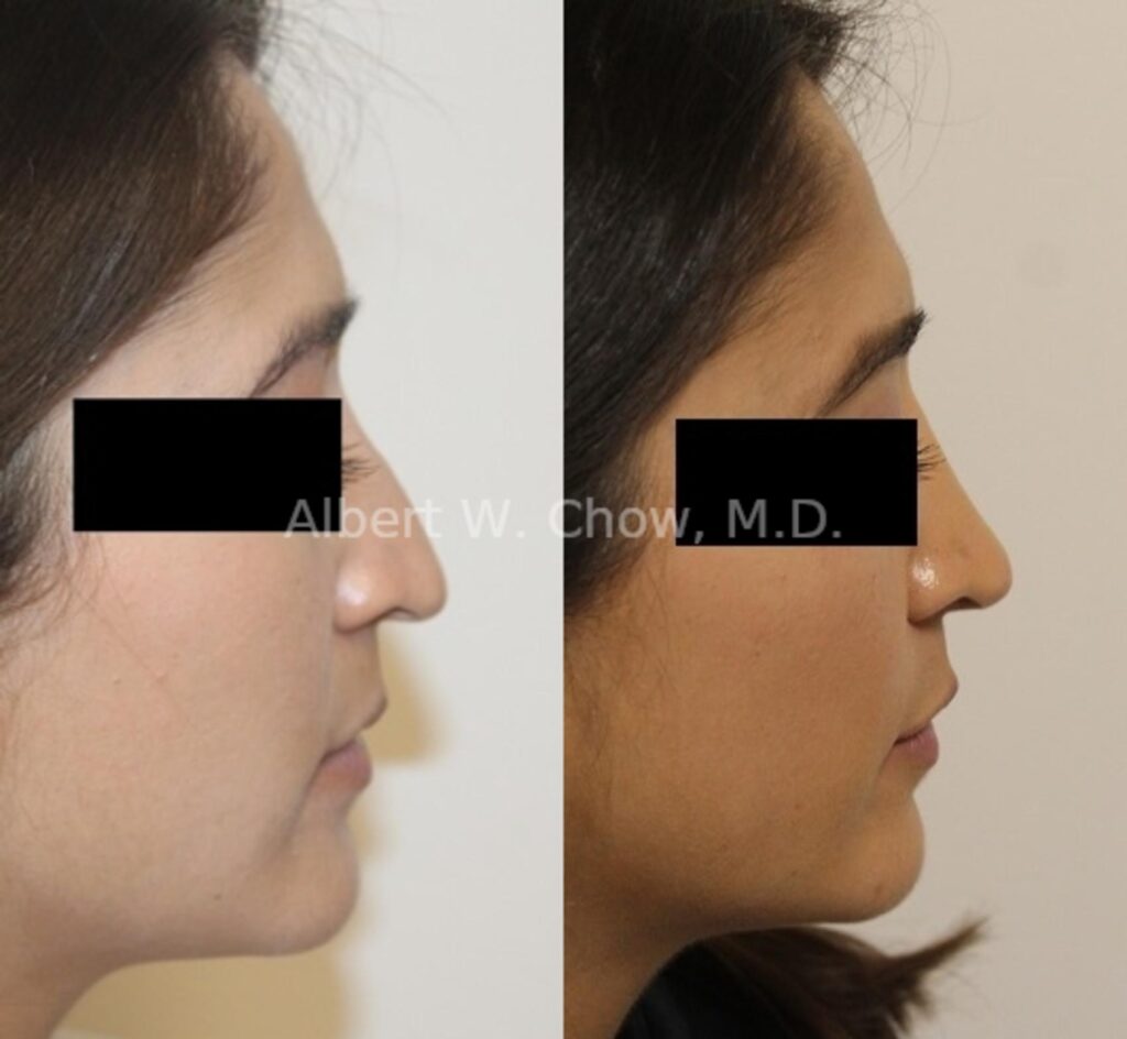 Rhinoplasty Costs San Francisco California