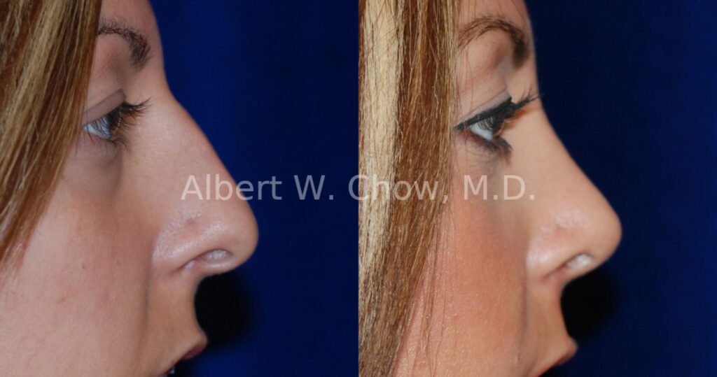 Rhinoplasty Costs San Francisco California