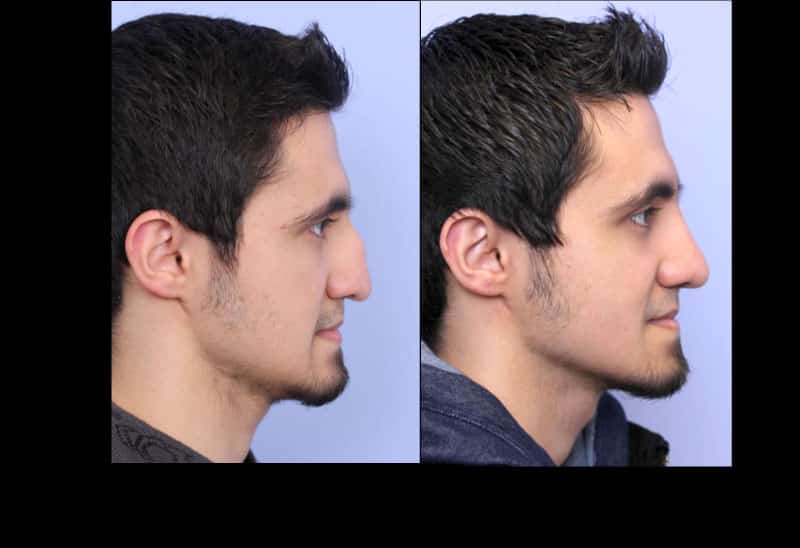 Rhinoplasty Costs San Francisco California
