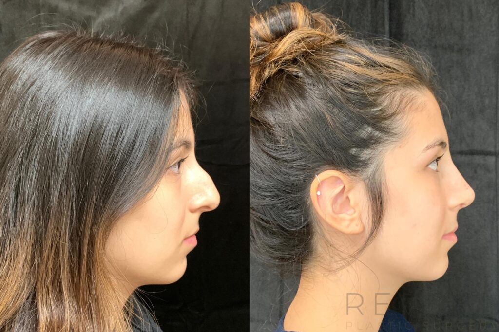 Rhinoplasty Costs San Jose California