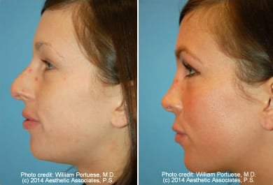Rhinoplasty Costs Seattle Washington Rhinoplasty Costs Seattle Washington