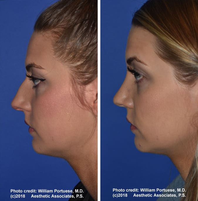 Rhinoplasty Costs Seattle Washington Rhinoplasty Costs Seattle Washington
