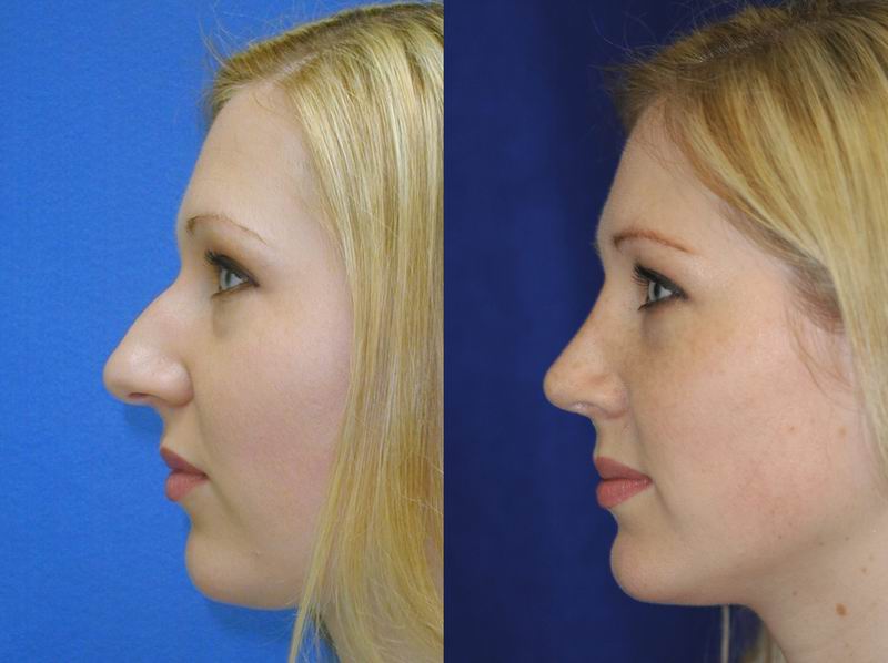 Rhinoplasty Costs Seattle Washington Rhinoplasty Costs Seattle Washington