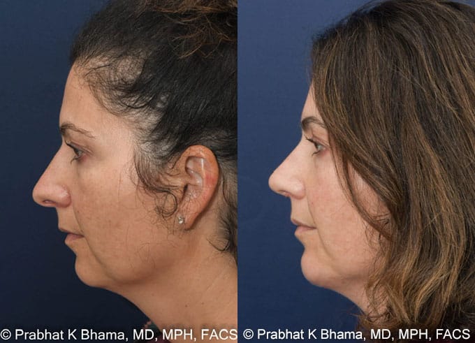 rhinoplasty costs seattle washington 5
