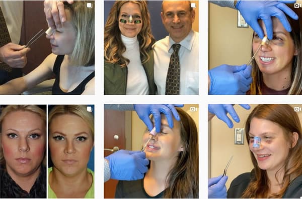 Rhinoplasty Costs Seattle Washington Rhinoplasty Costs Seattle Washington