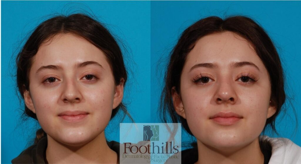 Rhinoplasty Costs Tucson Arizona Rhinoplasty Costs Tucson Arizona
