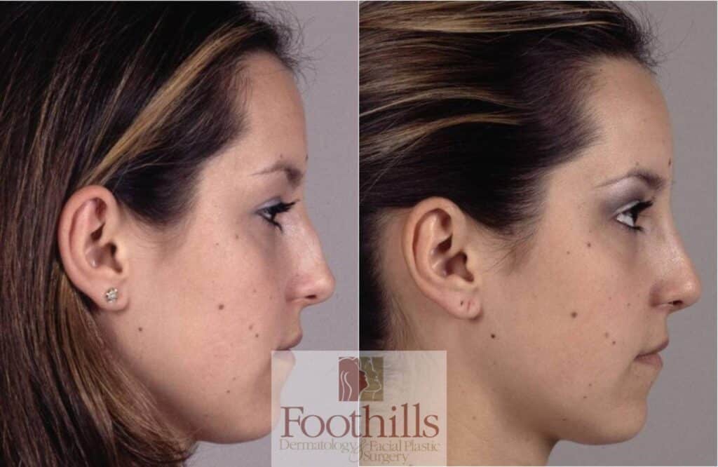 Rhinoplasty Costs Tucson Arizona Rhinoplasty Costs Tucson Arizona