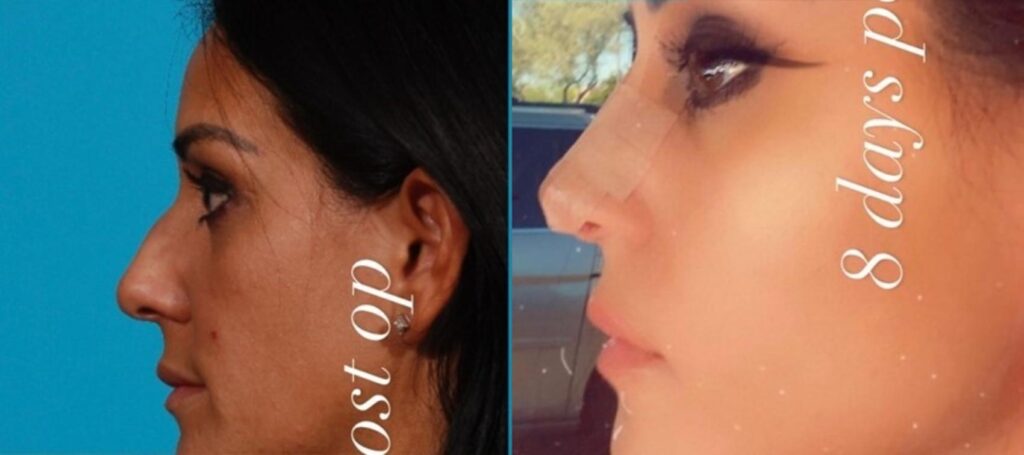 Rhinoplasty Costs Tucson Arizona Rhinoplasty Costs Tucson Arizona