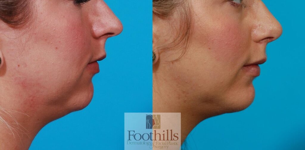Rhinoplasty Costs Tucson Arizona Rhinoplasty Costs Tucson Arizona