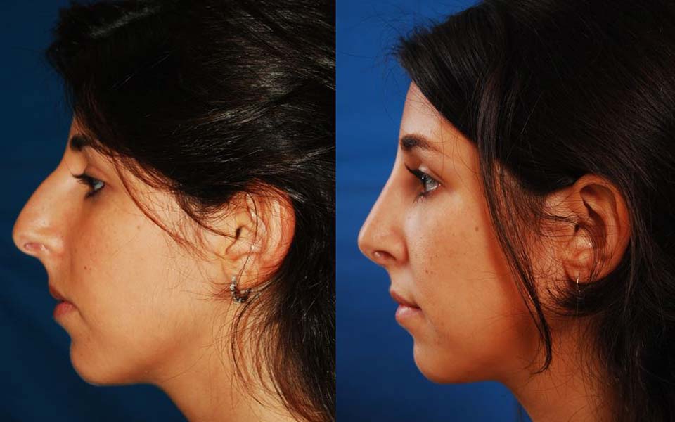Rhinoplasty Costs Washington District Of Columbia