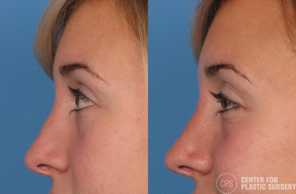 Rhinoplasty Costs Washington District Of Columbia