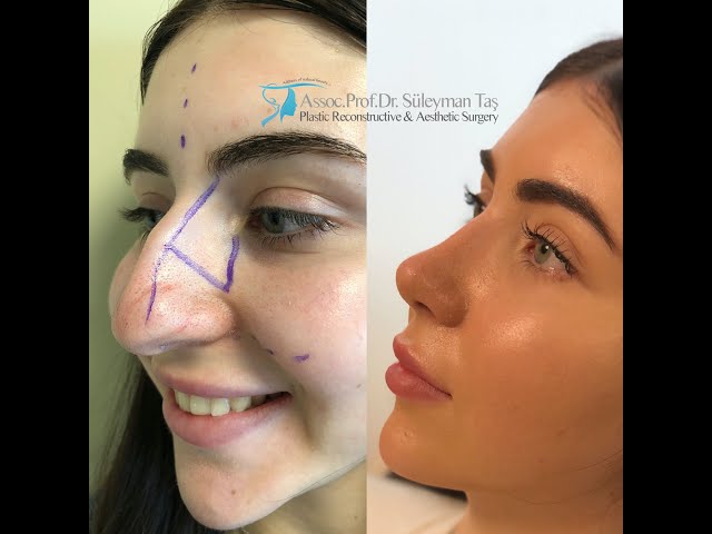 Rhinoplasty Patient Experiences Rhinoplasty Patient Experiences