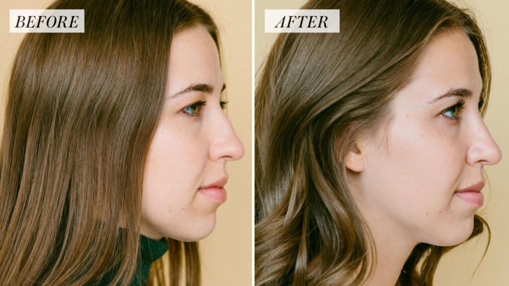 Rhinoplasty Patient Experiences Rhinoplasty Patient Experiences