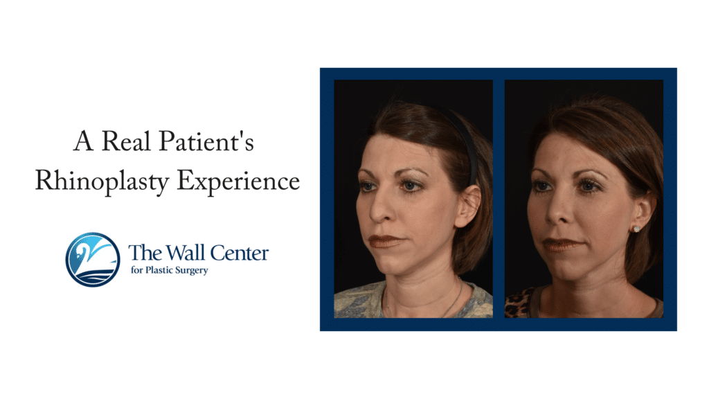 Rhinoplasty Patient Experiences Rhinoplasty Patient Experiences