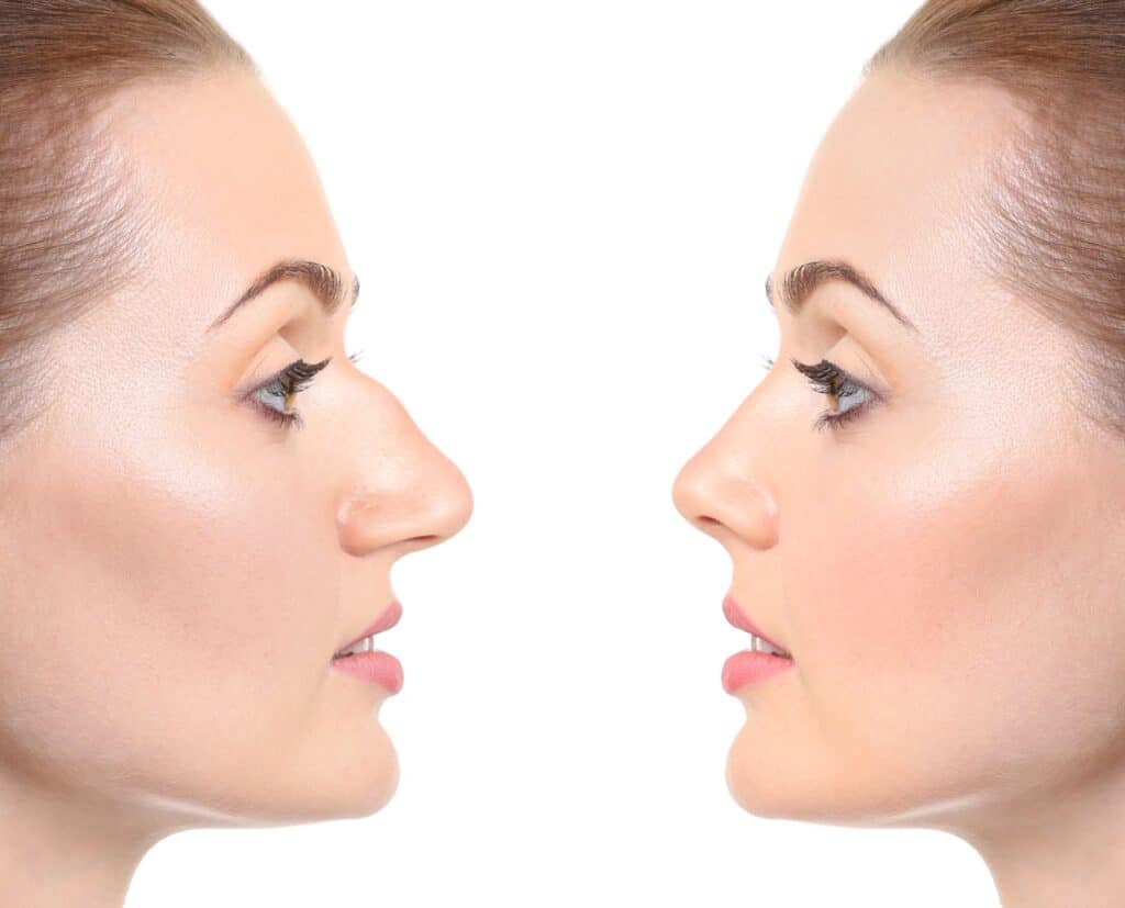 Rhinoplasty Procedure Costs