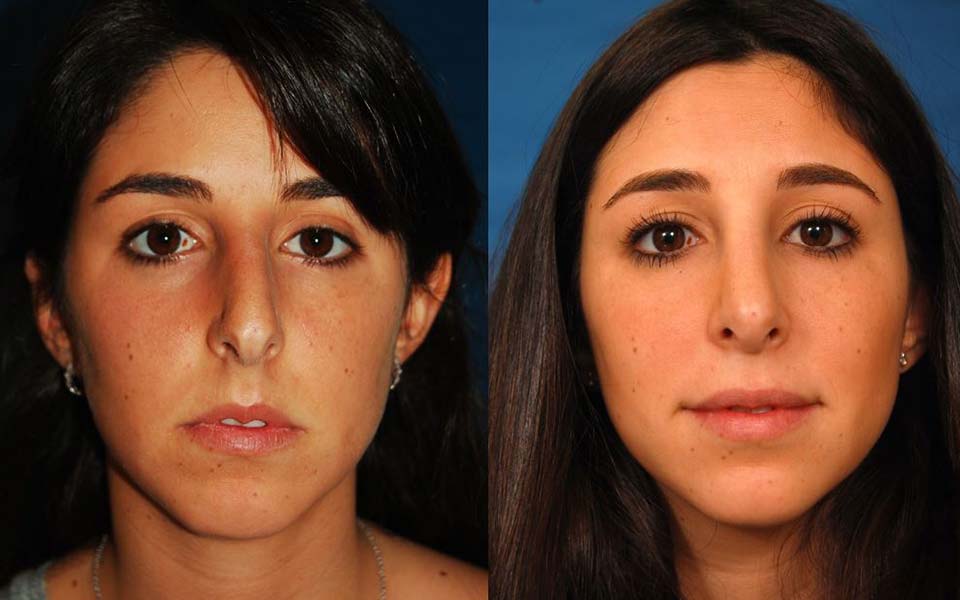 The Average Cost Of Rhinoplasty
