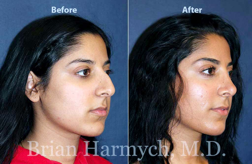 The Average Cost Of Rhinoplasty