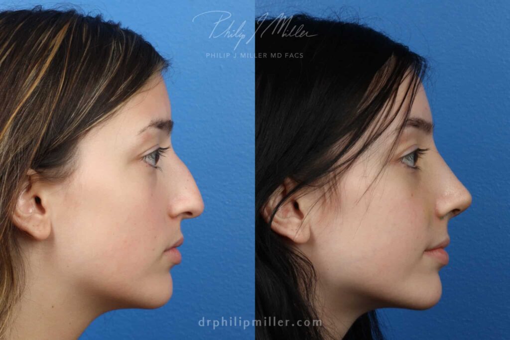 The Average Cost Of Rhinoplasty