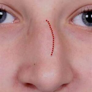 rhinoplasty costs augusta richmond county georgia 3