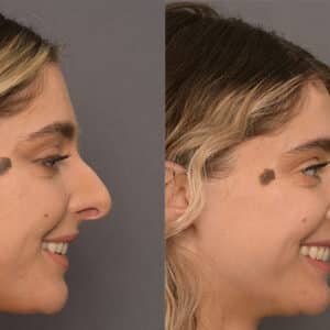 rhinoplasty costs bakersfield california
