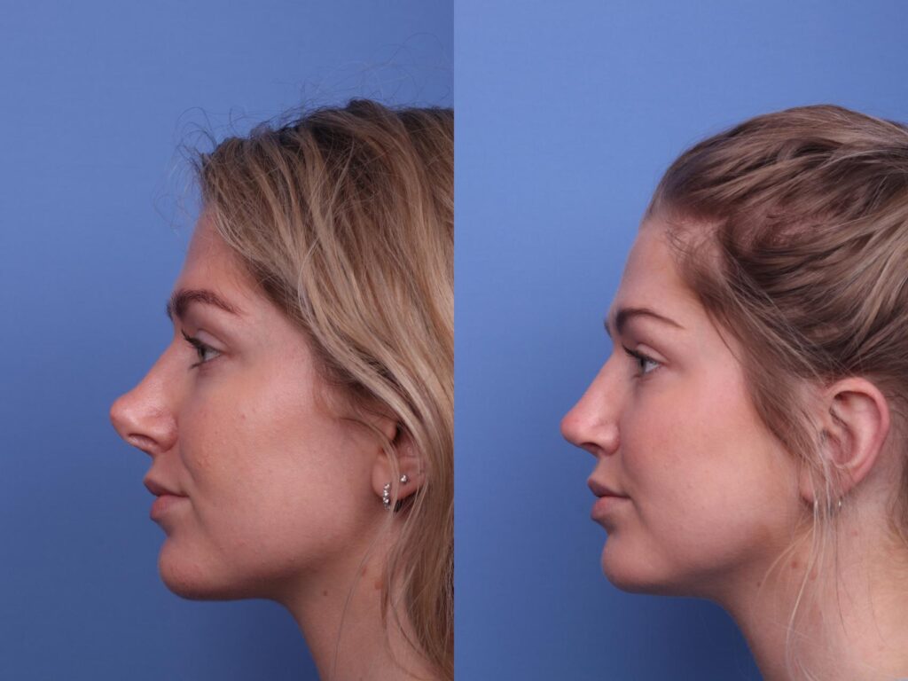Rhinoplasty Costs Chandler Arizona Rhinoplasty Costs Chandler Arizona