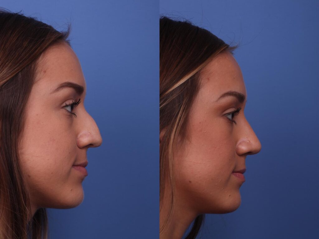 Rhinoplasty Costs Chandler Arizona Rhinoplasty Costs Chandler Arizona