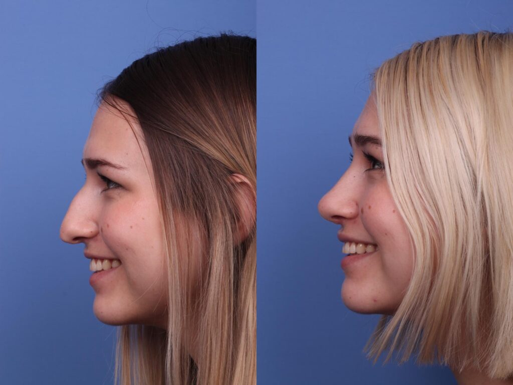 Rhinoplasty Costs Chandler Arizona Rhinoplasty Costs Chandler Arizona