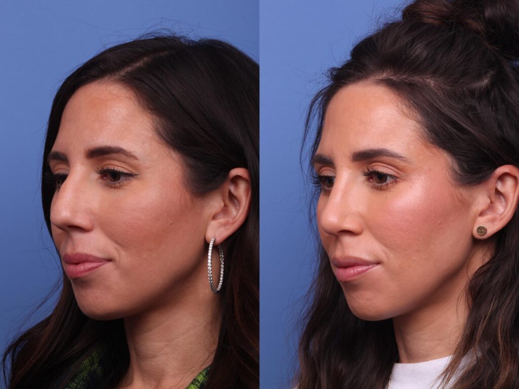 Rhinoplasty Costs Chandler Arizona Rhinoplasty Costs Chandler Arizona