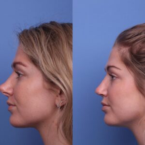 rhinoplasty costs chandler arizona 5