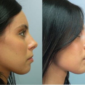 rhinoplasty costs chattanooga tennessee