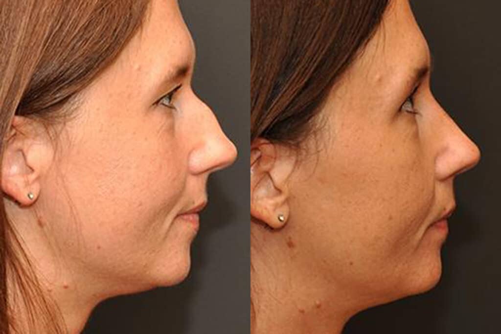 Rhinoplasty Costs Cincinnati Ohio