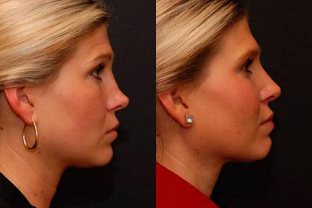 Rhinoplasty Costs Cincinnati Ohio