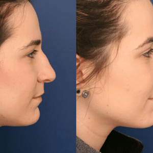 rhinoplasty costs columbia south carolina 5