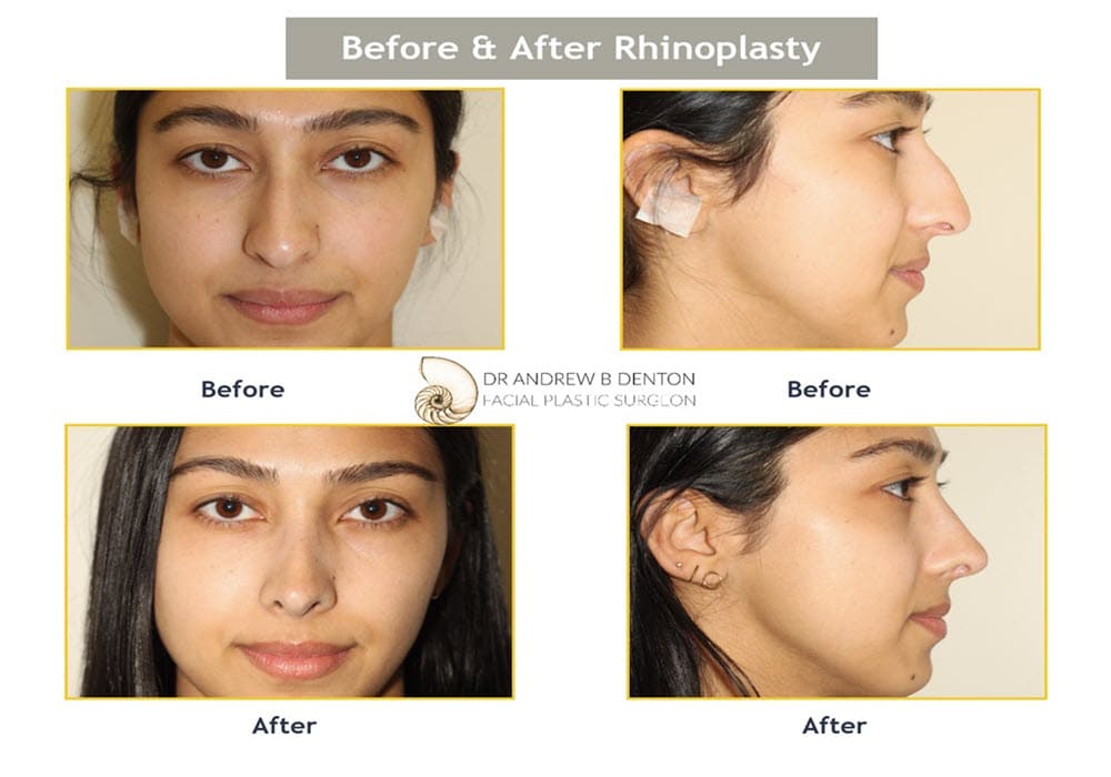 Rhinoplasty Costs Denton Texas