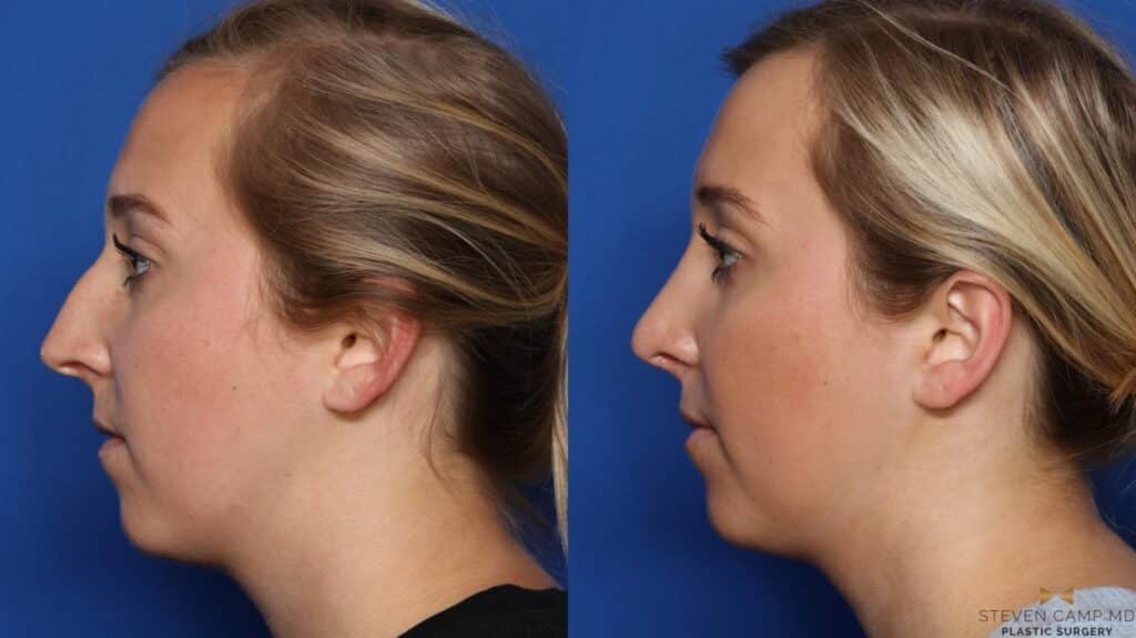 Rhinoplasty Costs Denton Texas