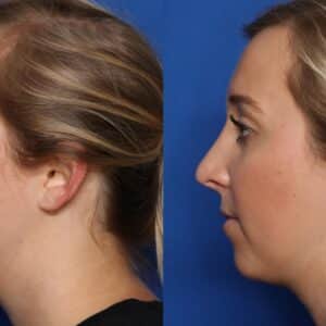 rhinoplasty costs denton texas 5