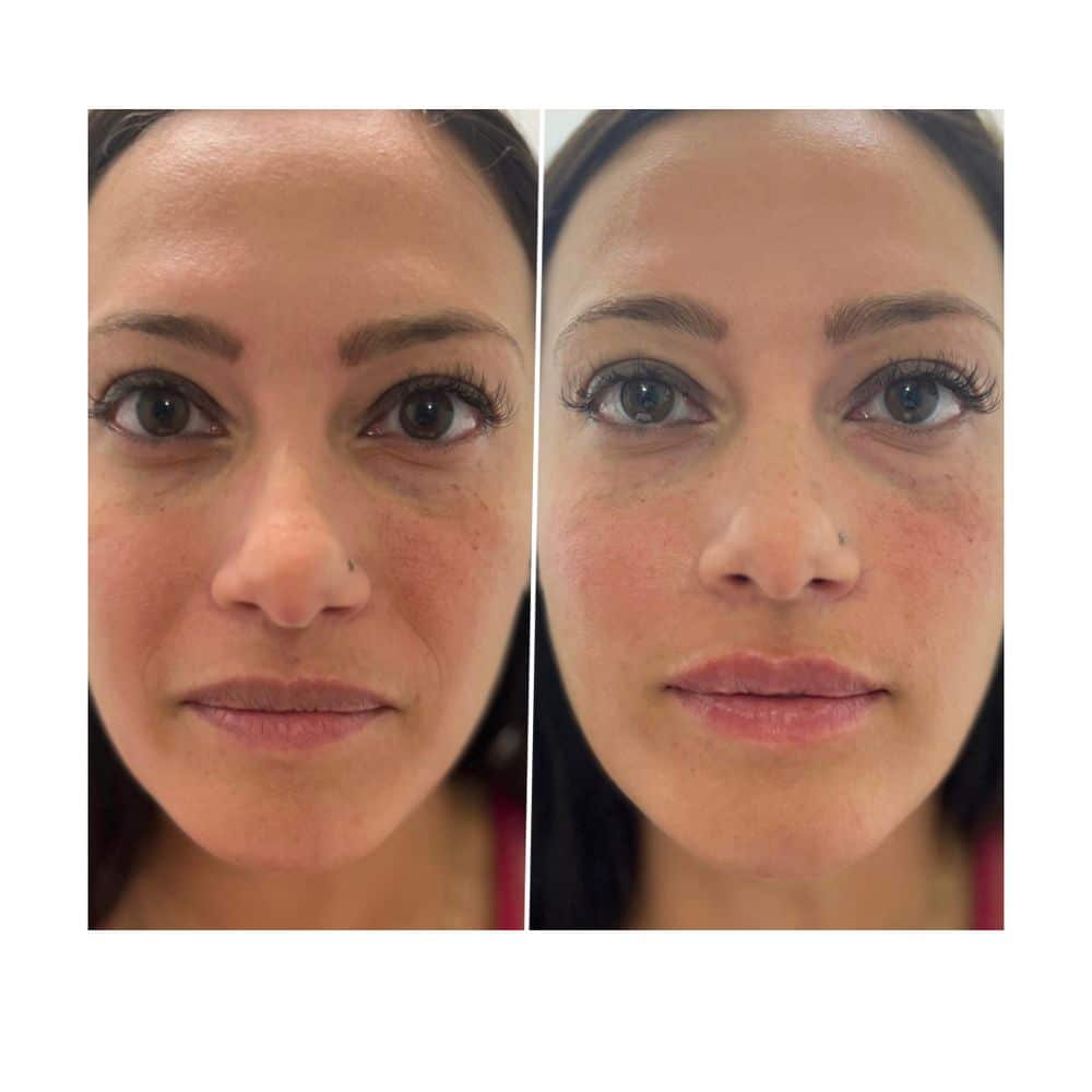 Rhinoplasty Costs Elk Grove California Rhinoplasty Costs Elk Grove California